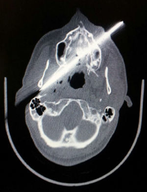Imagen de tomografía axial computarizada (TAC) donde se muestra cuerpo extraño (cuchillo) que se introduce por región maxilar izquierda atravesando paladar duro y cavidad oral. Su punta provoca una subluxación de la articulación temporomandibular y lesión parafaríngea derecha con burbujas aéreas.