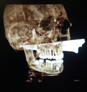 Reconstrucción de imagen de TAC donde se aprecia el arma blanca atravesando la cavidad oral.