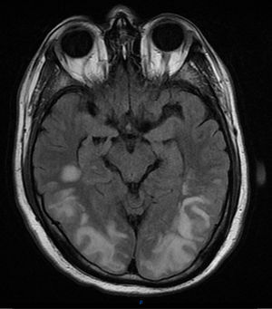 RMN craneal axial inicial imagen T2. Se puede ver las áreas hiperintensas que afecta a la sustancia blanca de los lóbulos parietal y occipital con ligera afectación cortical.