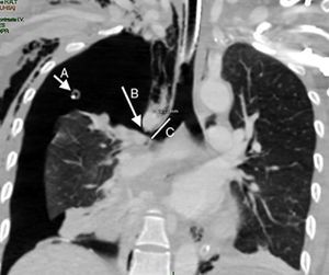 Neumotórax total derecho. La flecha A muestra un corte del drenaje pleural. La flecha B indica la rotura bronquial derecha a 2cm de la carina traqueal (líneaC).