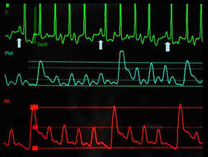 Repercusión hemodinámica de la arritmia. Diferencia en la onda de pulso arterial (trazado inferior) y la onda de saturación de oxígeno (trazado intermedio) entre los latidos en ritmo sinusal (trazado superior, flechas) y los latidos de la taquicardia.