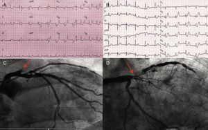 ECG y coronariografías de los casos 1 (A y C) y 2 (B y D) que muestran patrón ST-T de Winter y oclusión/suboclusión de ADA ostial.