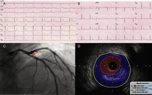 ECG con dolor torácico previo (A) y posterior a intervencionismo (B). Coronariografía que muestra lesión angiográficamente límite en ostium de ADA (C), significativa por IVUS (D).