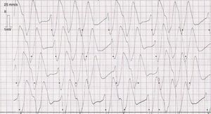 Registro de monitorización electrocardiográfica del paciente. Se observa conducción intraventricular.