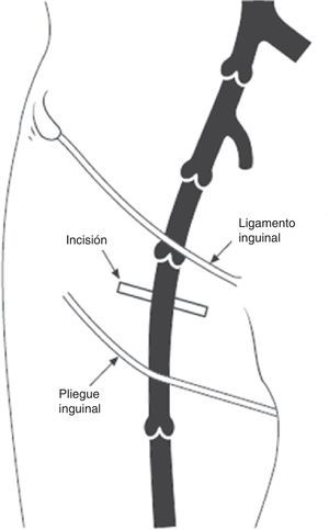 Esquema que representa la zona de realización de la bolsa del generador de forma caudal al ligamento inguinal.