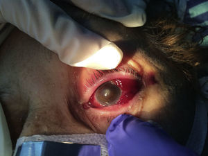 Imagen del ojo izquierdo de la paciente, donde se observa enrojecimiento y edema conjuntival, y opacificación del cristalino.