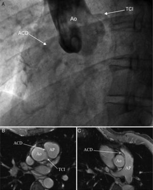 A) Aortografía que muestra la ausencia del origen de la arteria coronaria derecha (ACD) desde el seno de Valsalva derecho. B y C) Cortes consecutivos de resonancia magnética cardiaca en plano axial a nivel de grandes vasos mostrando el origen normal del tronco común izquierdo (TCI), y el origen anómalo de la ACD desde el seno de Valsalva izquierdo con marcada angulación en su salida y trayecto interarterial entre tronco de la arteria pulmonar (AP) y aorta (Ao).