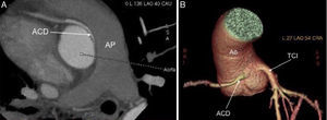 Tomografía computarizada multi-detector: A) Plano axial; B) Reconstrucción 3D-volume rendering, que muestran el origen normal del tronco común izquierdo (TCI) y el origen anómalo de la arteria coronaria derecha (ACD) desde el seno de Valsalva izquierdo con marcada angulación en su salida, y trayecto interarterial entre tronco de la arteria pulmonar (AP) y aorta (Ao).