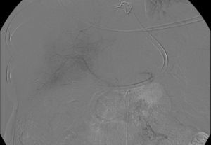 Imagen de arteriografía que muestra repermeabilización parcial de vena porta. Imagen obtenida durante intervencionismo radiológico de control posterior a tratamiento fibrinolítico locorregional.