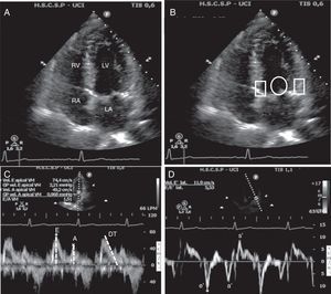 Echocardiographic assessment of left ventricular diastolic function. (A) Apical four-chamber view. In this view must check the left atrium volume and size and the left ventricle and septum size. (B) Apical four-chamber view, circle shows position where pulse wave Doppler has to be placed to measure transmitral flow, whereas rectangles show position where tissue Doppler must be placed to measure the velocity of change in myocardial length. (C) Pulse wave mitral Doppler at the tip of the mitral valve showing a normal diastolic pattern with a biphasic velocity profile E and A waves. Measurement of E wave deceleration time. (D) Tissue Doppler measurement at the lateral insertion site of the mitral leaflets shows the diastolic e′ and a′ waves and systolic s′ wave. LA, left atria; RA, right atria; LV, left ventricle; RV, right ventricle; DT, deceleration time.