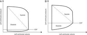 Pressure–volume curves of a healthy subject (A) and a patient with diastolic dysfunction (B), note the increase of end-diastolic pressure (EDP) for the same end-diastolic volume in case of diastolic dysfunction.