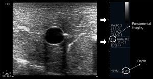 Proper basic technical parameters to optimize the image for vascular cannulation. The focus zones, which are two in this case (arrows), are positioned in superficial tissues and in line with the vessel, so as to improve resolution in these regions, thus best delineating the vessel and its surrounding structures and further recognizing the needle and its insertion in the vessel. Depth must be adjusted involving the vessel posterior wall and the structures behind it, in order to select or discard a vessel for cannulation (e.g. artery over vein overlapping) and to readily detect an inadvertent puncture of the vessel posterior wall. Proper gain adjustment (general gains and near-far field gains using the time-gain compensation controls) are essential: too high gains can mask the echogenicity of the needle between the tissues, while too low gains may obscure the echogenicity of the needle as well as the vessel. Finally, using fundamental imaging is advocated, since tissue harmonic imaging is associated with poorer needle recognition.