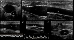 Ultrasonographic (US) appearance of the vessels. (A) Vessels in short axis, v: vein; a: artery; (B) vein (v) in long axis; (C) artery (a) in long axis; (D) vein flow demonstrating phasicity at spectral Doppler; (E) arterial flow demonstrating pulsatility at spectral Doppler; (F) differences between a superficial vein (sv, above deep fascia and muscle) and a deep vein (dv).