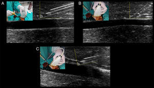 Optimal needle-beam angle for best needle recognition. Dotted yellow line represents the 90 degrees in relation with the beam, illustrated by the solid yellow line. Solid white line represents the needle and its angle in relation with the beam. (A) Shallow needle-beam angle of insertion, allowing for perfect observation of the needle body and the bevel (facing up). Needle reverberation artifacts are also evident. (B) A slopped angle of insertion is shown, and needle visualization is blurred between the tissues. (C) With the needle in the angulation of B, inclining the transducer (“heel-toe” maneuver) greatly enhances needle visualization through approaching the need-beam angle toward 90 degrees.