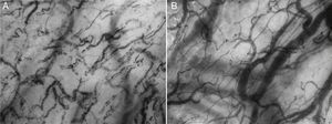 Cytocam-Incident Dark Field (IDF) images of sublingual microcirculation. Image A: early phase septic shock patient. A decrease of vessel density and of perfused vessels, and an increase of non-perfused/under-perfused vessels can be observed. Although not appreciable in static images, heterogeneity of microvascular blood flow velocity between coexisting areas is also present (normal or high microvascular blood flow vessels in close vicinity to non-perfused or low microvascular blood flow vessels). Image B: healthy volunteer. A normal vessel density and proportion of perfused vessels can be observed. Although not appreciable in static images, microvascular blood flow velocity is normal and homogeneous overall the studied areas. (Images courtesy of Braedius Medical and Prof. D. Payen, H. Lariboisiere).
