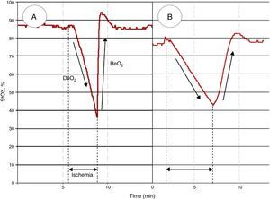Different StO2 patterns in response to a vascular occlusion test (VOT) in healthy subjects and septic shock. Figure A shows a normal StO2 response to a VOT, whereas figure B shows an altered response in a septic shock patient. Note that, independently of the baseline absolute StO2 value, the response to ischemia is different. The DeO2 slope is slower, and a longer period in order to reach a predetermined ischemic threshold (i.e. 40%)34 is needed. The vascular reactivity is also impaired, leading to a slower StO2 recovery rate (ReO2), and a blunted hyperemic response before returning to baseline StO2.