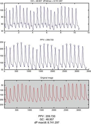 Captura de la app Capstesia (GalenicApp®, Vitoria-Gasteiz, España), en la que se pueden observar los cálculos hemodinámicos obtenidos a partir de la fotografía de una presión arterial invasiva que figuran en la parte inferior de la imagen.