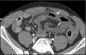 TC de abdomen con contraste intravenoso, donde existe ausencia de realce de un segmento yeyunal sugerente de isquemia (flechas).