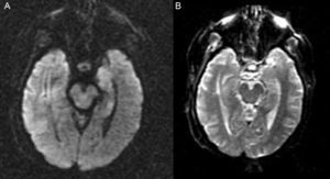 RMN cerebral ([A]: estudio en difusión, y [B]: coeficiente ADC). En el estudio de difusión muestra hiperintensidad con discreto descenso del coeficiente ADC en la región hipocámpica del lóbulo temporal izquierdo.