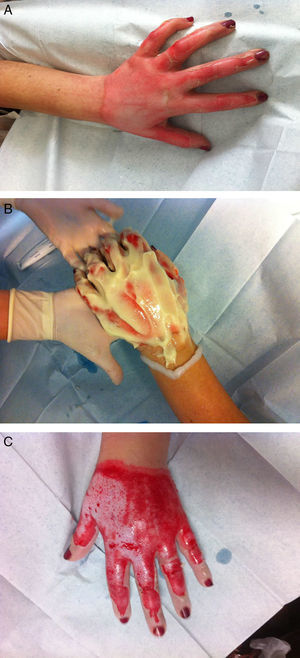 (A) Female 44 years. Flame burn in left hand. (B) Nexobrid being applied 24h post burn. (C) Four hours after enzymatic debridement. No surgical procedure was needed.