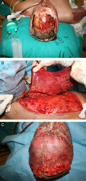 (A) Young male sustaining a flame burn after a car crash. Note the exposed bone. (B) Latissimus dorsi flap being harvested based on thoracodorsal artery via the subscapular artery. (C) The important scalp defect was covered and grafted. (Photos courtesy of Dra. Lagares Borrego).