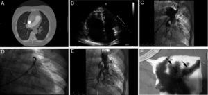 A) Angio-TC de arterias pulmonares mostrando contenido trombótico en ambas arterias pulmonares principales. B) Ecocardiograma transtorácico, plano apical 4 cámaras, dilatación severa de ventrículo derecho. C) Angiografía pulmonar izquierda basal. D) Fragmentación con catéter pigtail. E) Angiografía pulmonar izquierda tras trombectomía mecánica. F) Contenido trombótico aspirado (flechas).
