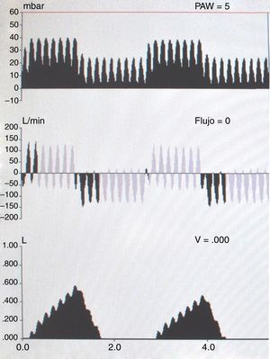 VPI conectado en serie en paciente bajo ventilación mecánica convencional en modo controlado por presión.