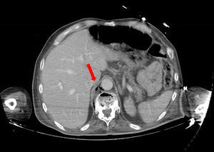 Corte axial TAC de abdomen.