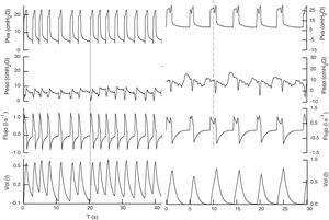 Registro de las señales (Pva, Pes, flujo, vol) en presión soporte de los 2 pacientes. En el primero de 18 con PEEP de 5cmH2O, mejorando la interacción con el respirador, el esfuerzo precede al ciclo mecánico (línea continua), con una frecuencia respiratoria de 22rpm, realiza un volumen corriente de 0,450l, sin signos de excesivo esfuerzo respiratorio y con un delta de presión esofágica menor de 5cmH2O. En el segundo caso con presión soporte de 25 y PEEP 6, mantiene una frecuencia respiratoria de 12rpm y un volumen corriente de 0,783l. En este el esfuerzo del paciente es posterior al inicio del ciclo mecánico, posiblemente el trigger del respirador es el cambio de presión (o flujo) provocado por el latido cardiaco. El esfuerzo del paciente (línea discontinua) produce un descenso en la fase de meseta de la presión de la vía aérea, que origina un reascenso del flujo inspiratorio.