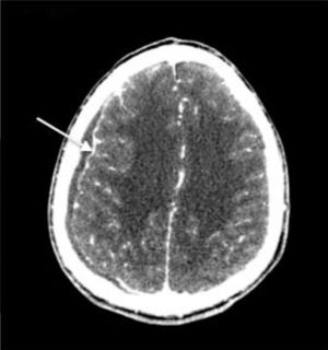 TC craneal con contraste (corte axial). Colección extraaxial hipodensa subdural derecha, con realce periférico y efecto masa.