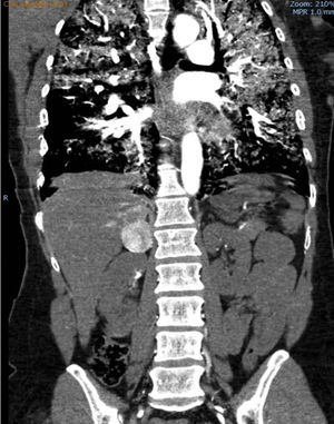 TAC toraco-abdominal con contraste con imagen de ocupación alveolar bilateral y lesión hipercaptante suprarrenal derecha.