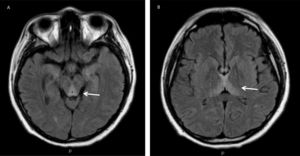 Lesiones hiperintensas en tronco cerebral, fórnix y tálamo bilateral.