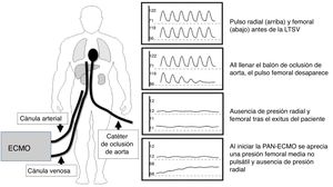 Esquema propuesto para confirmar la correcta posición del balón para la oclusión aórtica.