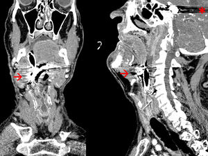 Cortes de la TAC craneal, coronal y sagital con artefactos metálicos.