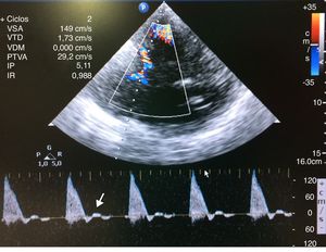 Registro de dúplex transcraneal codificado color. Patrón de flujo sistólico en ACM izquierda. Se aprecia la ausencia de flujo diastólico (flecha blanca).