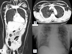 A) Escanograma del paciente, observándose importante enfisema subcutáneo postraumatismo. B) Tomografía computarizada, corte axial. Bullas pulmonares bilaterales y enfisema subcutáneo. C) Radiografía de tórax tras colocación de dos tubos pleurales derechos.