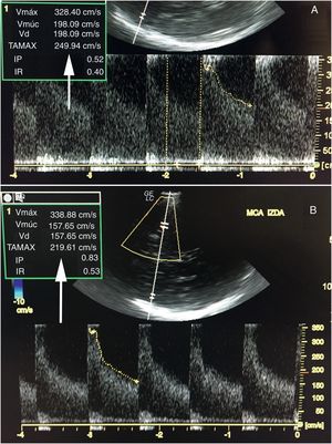 Técnica de bloqueo bajo escopia.