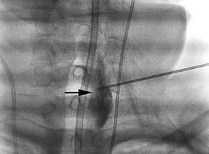 Medida de Vm en ACM izquierda DTC antes (A) del bloqueo y tras el bloqueo (B).