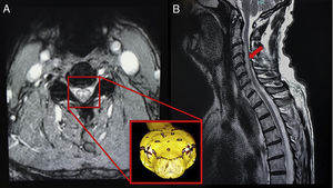 Imágenes de RM ponderadas en T2. En corte axial pone de manifiesto la lesión en «ojos de serpiente», signo sugestivo de infarto medular. En plano sagital muestra hiperintensidad de señal central, a modo de «trazo de lápiz» (signo «pencil-like»).