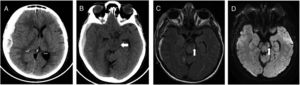 Brain CT showed extended right-sided subdural haematoma (A), with compression of left cerebral peduncle against free tentorial (B, white arrow). Brain MRI reveals a rounded hyperintense T2 FLAIR (C) and DW1 (D) images in left cerebral peduncle (white arrow), at 2 days after initial injury.