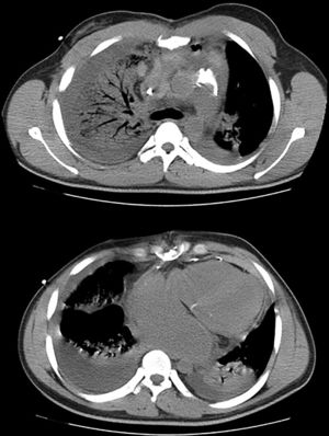 Tomografía computarizada: consolidación alveolar en el lóbulo superior del pulmón derecho y hematoma mediastínico moderado.