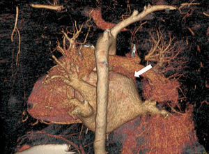 Reconstrucción de tomografía computarizada con contraste: colapso de la vena pulmonar superior derecha proximal a su entrada en aurícula izquierda (flecha blanca).