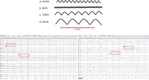 Ondas cerebrales normales. a. Alfa (8-12Hz), b. Beta (13-30Hz), c. Zeta (4-7Hz), d. Delta (0,1-3Hz).
