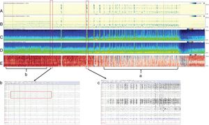 Cuatro horas de qEEG en un paciente de 56 años de edad con alteración del sensorio, fiebre y rigidez de nuca. El paciente fue diagnosticado con meningitis estreptocócica complicada con estatus epiléptico no-convulsivo. Múltiples convulsiones electrográficas fueron grabadas, originadas en el hemisferio derecho (evidenciado por la mayor amplitud en el hemisferio derecho con relación al hemisferio izquierdo. Paneles C y D) y (a) por el espectrograma de asimetría relativa (panel E) con mayor imagen roja (hemisferio derecho) que azul (hemisferio izquierdo). Además, (b) el espectrograma de asimetría relativa se observa de color rojo antes de la convulsión debido a la gran actividad interictal que se ve en el hemisferio derecho. Los paneles A y B son detectores de ritmicidad, una medida en la que el trazado se vuelve más oscuro cuando hay una actividad periódica o rítmica, y se observa como una banda oscura a la frecuencia de la actividad periódica. Este espectrograma muestra ritmicidad entre 1-25Hz y en este ejemplo se demuestra una asimetría de ritmicidad con predominancia del hemisferio derecho, especialmente en las frecuencias lentas (delta). (c) EEG demostrando una de las convulsiones de baja amplitud originada en el cuadrante posterior derecho (P4,P8,O2) que evoluciona de manera difusa sobre el hemisferio derecho, con una actividad delta monomórfica con picos sobreimpuestos. Esta actividad tiene un amplio campo sobre el hemisferio derecho.