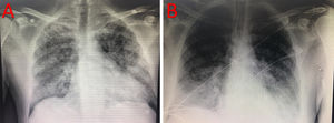 Imagen radiológica de un enfermo infectado por SARS-CoV-2. A) Infiltrado bilateral neumónico típico en 2019-n-CoViD. B) Evolución del mismo enfermo tras intubación orotraqueal y conexión a ventilación mecánica.