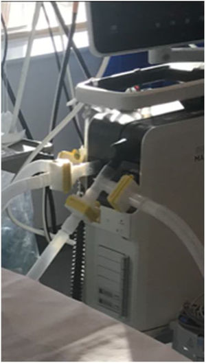 Two sets of standard ventilator tubing (Hudson) were connected to a single ventilator (tested in each model of ventilator, Puritan-Bennett, 840 series and a Servo I Maquet) via two T-tubes (one on the patient inflow limb of the circuit, and one on the patient exhaust limb). Each T-tube was attached to a microfilter (total of four) to isolated both patients and the ventilator. Especially if the circuit do not have in place non-return valves.