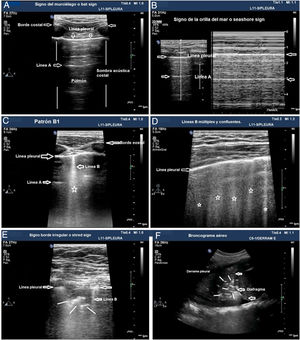 Patrones de aireación pulmonar. A) Patrón típico de aireación normal (perfil A en el protocolo BLUE) mostrando imagen en 2D. B) Patrón A en modo M. C) Patrón B1. D) Patrón B2. E) Consolidación pulmonar (perfil C en el protocolo BLUE), mostrando signo del borde irregular o shred sign. F) Broncograma aéreo. A, B, C, D y E: estudio con sonda lineal; F: sonda convex.