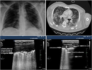 Paciente ingresado en UCI con neumonía por SARS-CoV-2. Paciente con neumonía por SARS-CoV-2 de dos semanas de evolución, con mejoría clínica y en la Rx simple de tórax, pero con persistencia de hallazgos patológicos en la ecografía pleural y en la TC.