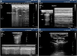 Signos en la ecografía pleural de barotrauma. A) Líneas E, artefacto vertical que no salen de la línea pleural en relación con enfisema subcutáneo. B) Patrón de líneas A y ausencia de deslizamiento pleural, que se confirma con el modo M, en la parte de la izquierda, que representa el signo de la estratosfera. C) Imagen confirmatoria de neumotórax y señala el punto de despegamiento de ambas pleuras visceral y parietal (lung point) en modo M. D) Imagen en 2D del punto pulmonar, zona de despegamiento de ambas pleuras.