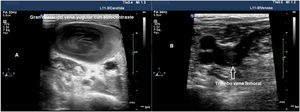 Imagen ecográfica de estado protrombótico. A) Imagen de un corte transversal de la vena yugular interna con aumento de ecogenicidad en su interior, secundario a un estado protrombótico. B) Imagen de corte transversal de la vena femoral común con un trombo no oclusivo en su interior.